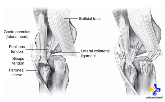 What Is A Patellar Tendon Tear? Symptoms, Treatment And Recovery