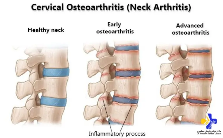 فرق دیسک گردن با آرتروز گردن چیست؟