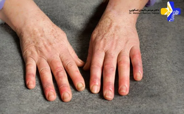 آیا تورم انگشت دست خطرناک است؟